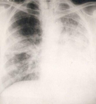 asbestosis pulmonar