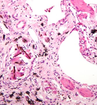 imagen microscópica de la fisiopatología de la asbestosis