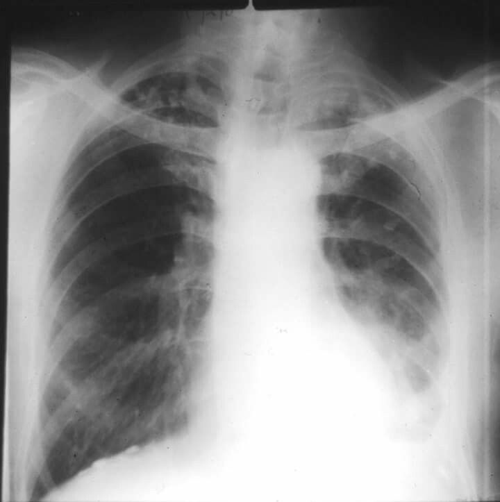 Asbestosis y Carcinoma Broncogénico  🧡 tratamiento y causas