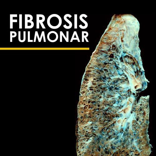 La Asbestosis provoca Fibrosis pulmonar 🧡 cáncer de pulmón