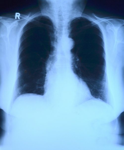 Radiología como método de diagnóstico 🧡 de Asbestosis