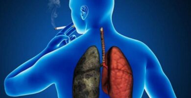 Trasplante pulmonar por asbestosis