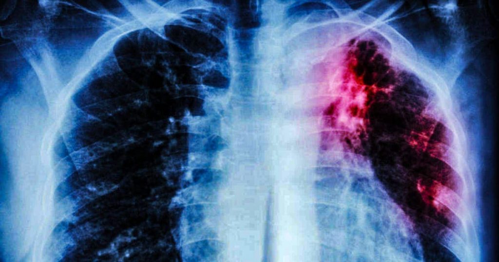 asbestosis y tuberculosis
