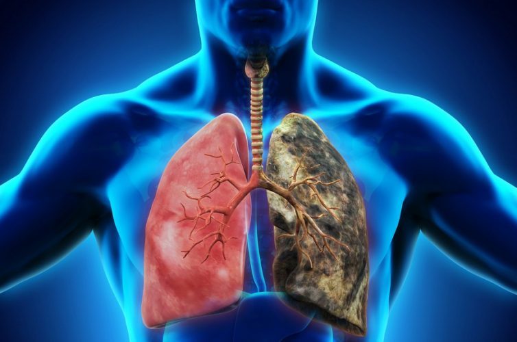 efecto de la asbestosis en los pulmones