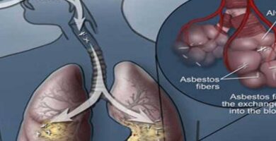 asbesto como agente cancerÃ­geno