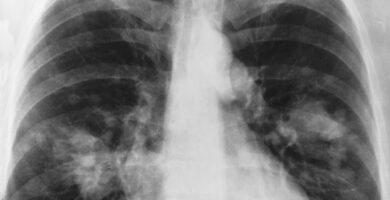 Asbestosis Pulmonar y Tuberculosis Juntos, Afectación por Fibrosis