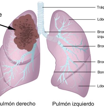 Asbestosis y Cáncer Pleural Maligno o Mesotelioma Pleural